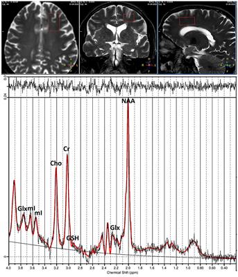 Proinflammatory Cytokines Predict Brain Metabolite Concentrations in the Anterior Cingulate Cortex of Patients With Bipolar Disorder